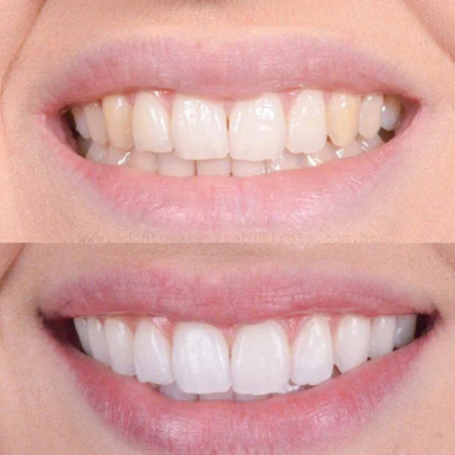 PearlWhite – Fast Teeth Whitening For A Radiant Smile